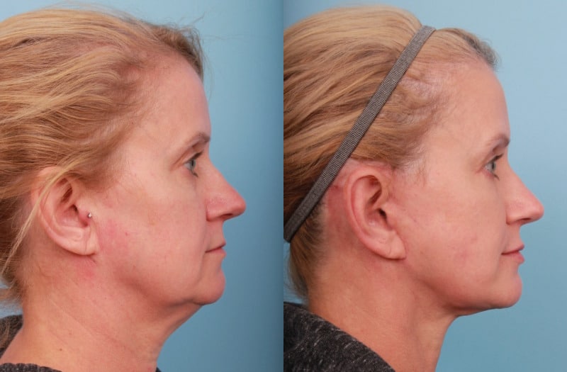 before_after_img