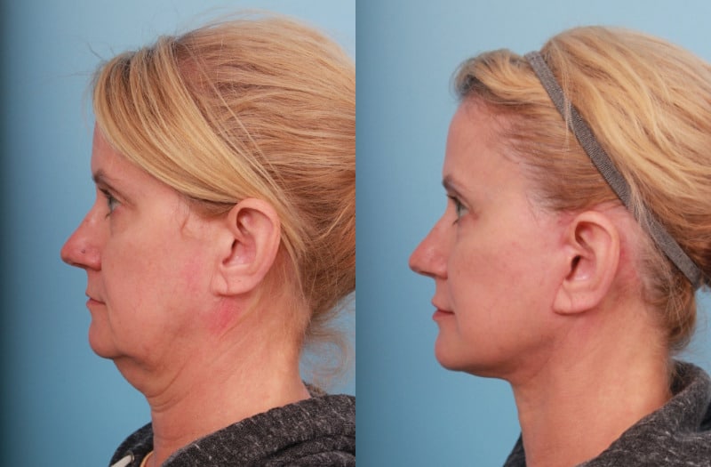 before_after_img