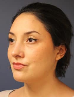 after rhinoplasty