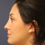 rhinoplasty-after-12