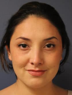after rhinoplasty
