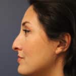 rhinoplasty-before-12