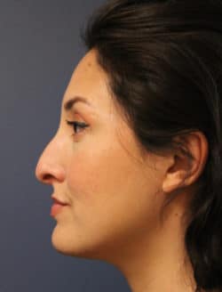 before rhinoplasty