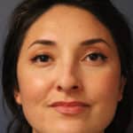 rhinoplasty-before-9