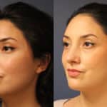 rhinoplasty-merged-10