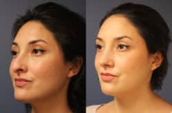 before and after rhinoplasty