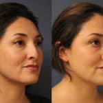 rhinoplasty-merged-11