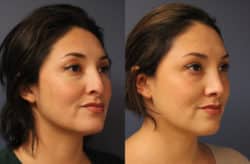 before and after rhinoplasty