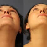 rhinoplasty-merged-14