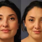 rhinoplasty-merged-9