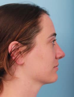 after rhinoplasty