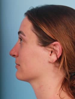 after rhinoplasty