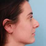 rhinoplasty-before-3