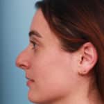 rhinoplasty-before-4