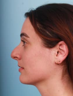 before rhinoplasty