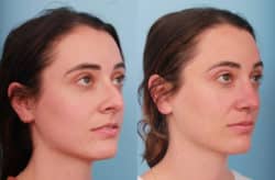before and after rhinoplasty