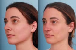 before and after rhinoplasty