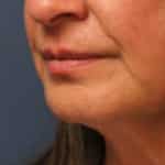 lip-lift-before-2