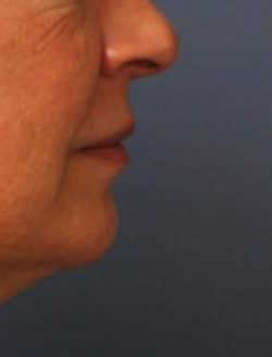 before lip lift