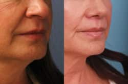 before and after lip lift