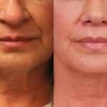 lip-lift-merged