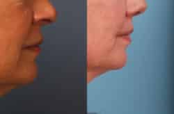 before and after lip lift