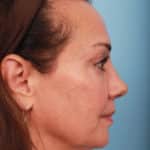rhinoplasty-after-13