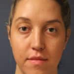 rhinoplasty-after-14