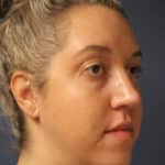 rhinoplasty-after-16