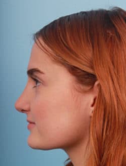 after rhinoplasty