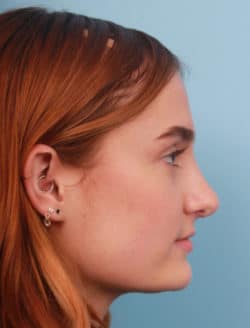 after rhinoplasty