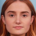 rhinoplasty-after-5