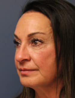 before rhinoplasty