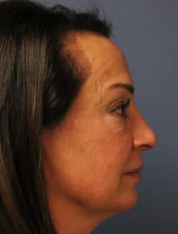 before rhinoplasty