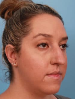 before rhinoplasty