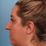 rhinoplasty-before-18