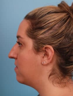 before rhinoplasty