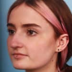 rhinoplasty-before-2