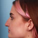 rhinoplasty-before-3
