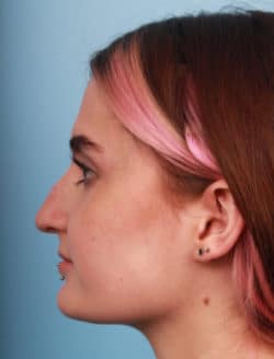 before rhinoplasty