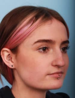 before rhinoplasty