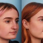 rhinoplasty-merged-1