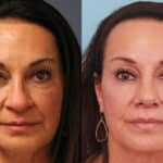rhinoplasty-merged-10