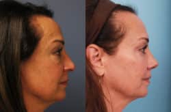 before and after rhinoplasty