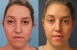 before and after rhinoplasty