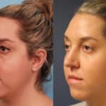 rhinoplasty-merged-15