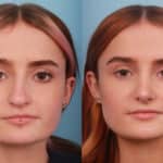rhinoplasty-merged