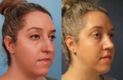 before and after rhinoplasty