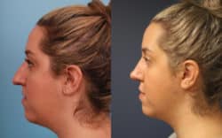 before and after rhinoplasty
