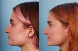 before and after rhinoplasty